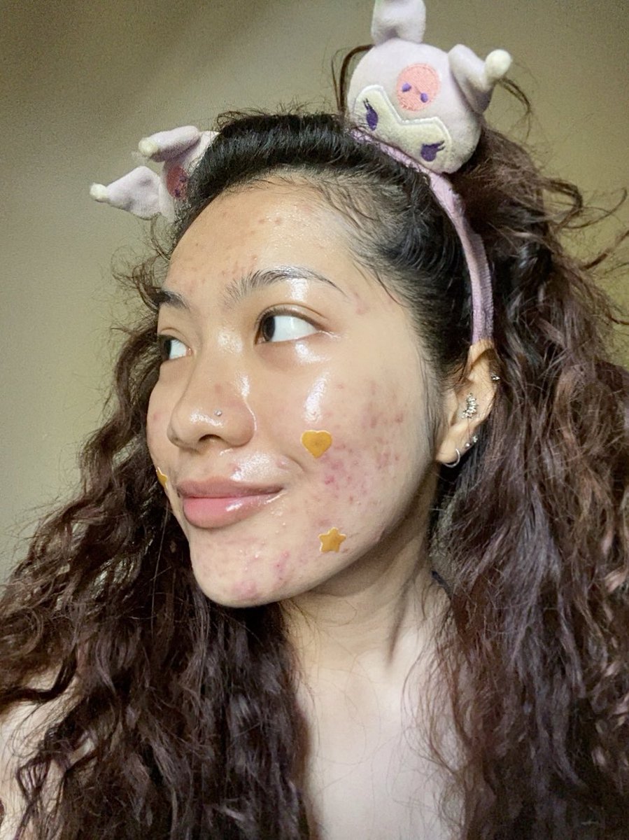 yanaazmill's tweet photo. From someone who's dealing with active acne, meh sini I nak share my experience and its effectiveness after using @tatagaltier's acne patches! 

#PoppyFlip💛🩷 https://t.co/Mjtzyu5qHQ