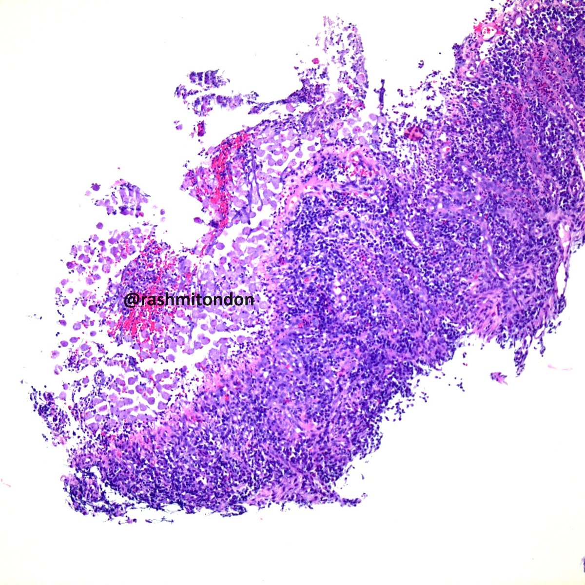 rashmitondon's tweet photo. Bugs usually bug the histopathologists, but is this a good one?
Entamoeba found in the friable area in the cecum on screening colonoscopy in an asymptomatic pt.
Erythrophagocytosis classically associated with E. histolytica, but not specific.
#pathology #GIpath #pathcritter https://t.co/Lt1JkBEU7R