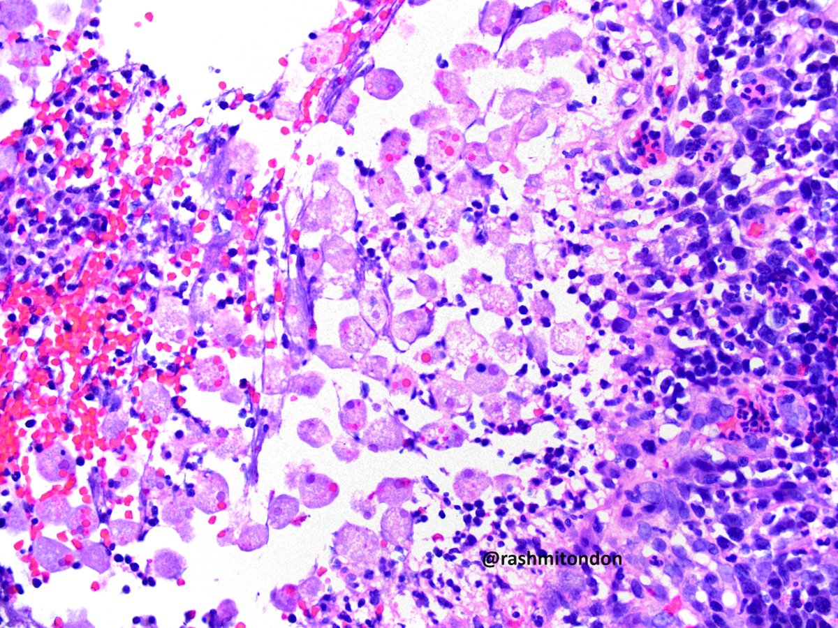 rashmitondon's tweet photo. Bugs usually bug the histopathologists, but is this a good one?
Entamoeba found in the friable area in the cecum on screening colonoscopy in an asymptomatic pt.
Erythrophagocytosis classically associated with E. histolytica, but not specific.
#pathology #GIpath #pathcritter https://t.co/Lt1JkBEU7R