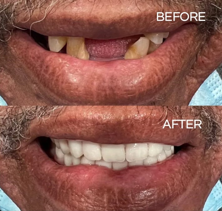 thetooth_dr's tweet photo. The before photo is of a patient with missing &amp; rotten teeth. The after photo was achieved with extractions of the upper, lower teeth &amp; the installation of a full denture.

#flossdental #thetoothdr #flossboss #beforeandafter #rottenteeth #repost #newimagedental #trinidadandtobago https://t.co/yvCStsjVps