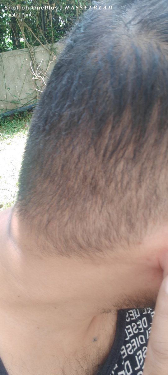 zenithharsh's tweet photo. @titaneyeplus look at the frame, left side and the right side are they in a proper balance? Look at my ear, how bad red they are after wearing and removing your tatti product spects. #cheatertitaneyeplus https://t.co/NcLdiBiwm9