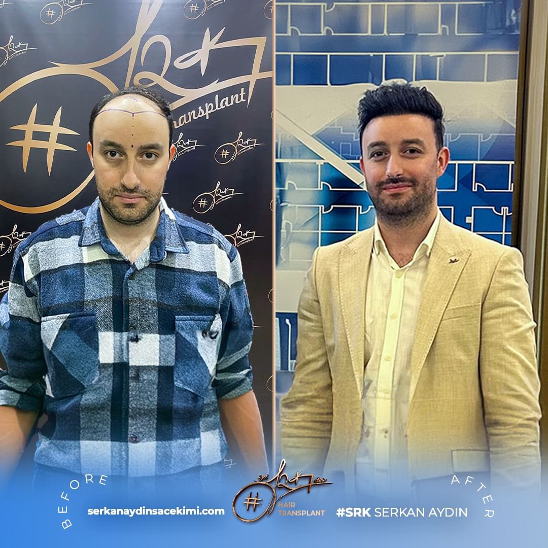 Arenamedd's tweet photo. Noch ein perfektes Ergebnis 😎
#hakankahraman
Kontaktieren Sie uns für kostenlos Haaranalyse 📱

#serkanaydin #maximumgrafts #hairtransplant #beardtransplant #stemcell #haartransplant #Stammzellen #maximalgraft #maximaktransplantation https://t.co/l8OBwJ4HKT