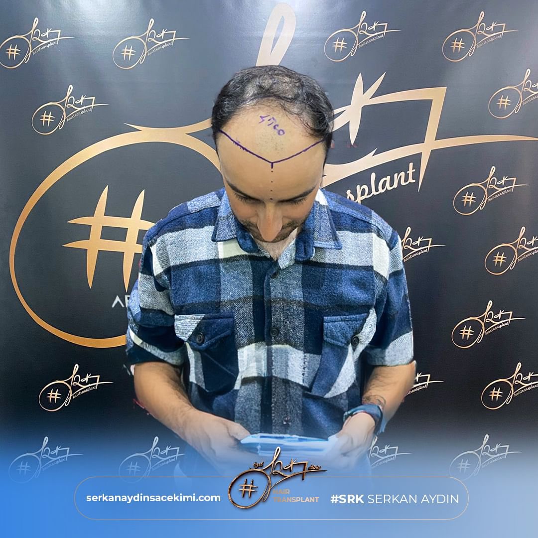 Arenamedd's tweet photo. Noch ein perfektes Ergebnis 😎
#hakankahraman
Kontaktieren Sie uns für kostenlos Haaranalyse 📱

#serkanaydin #maximumgrafts #hairtransplant #beardtransplant #stemcell #haartransplant #Stammzellen #maximalgraft #maximaktransplantation https://t.co/l8OBwJ4HKT