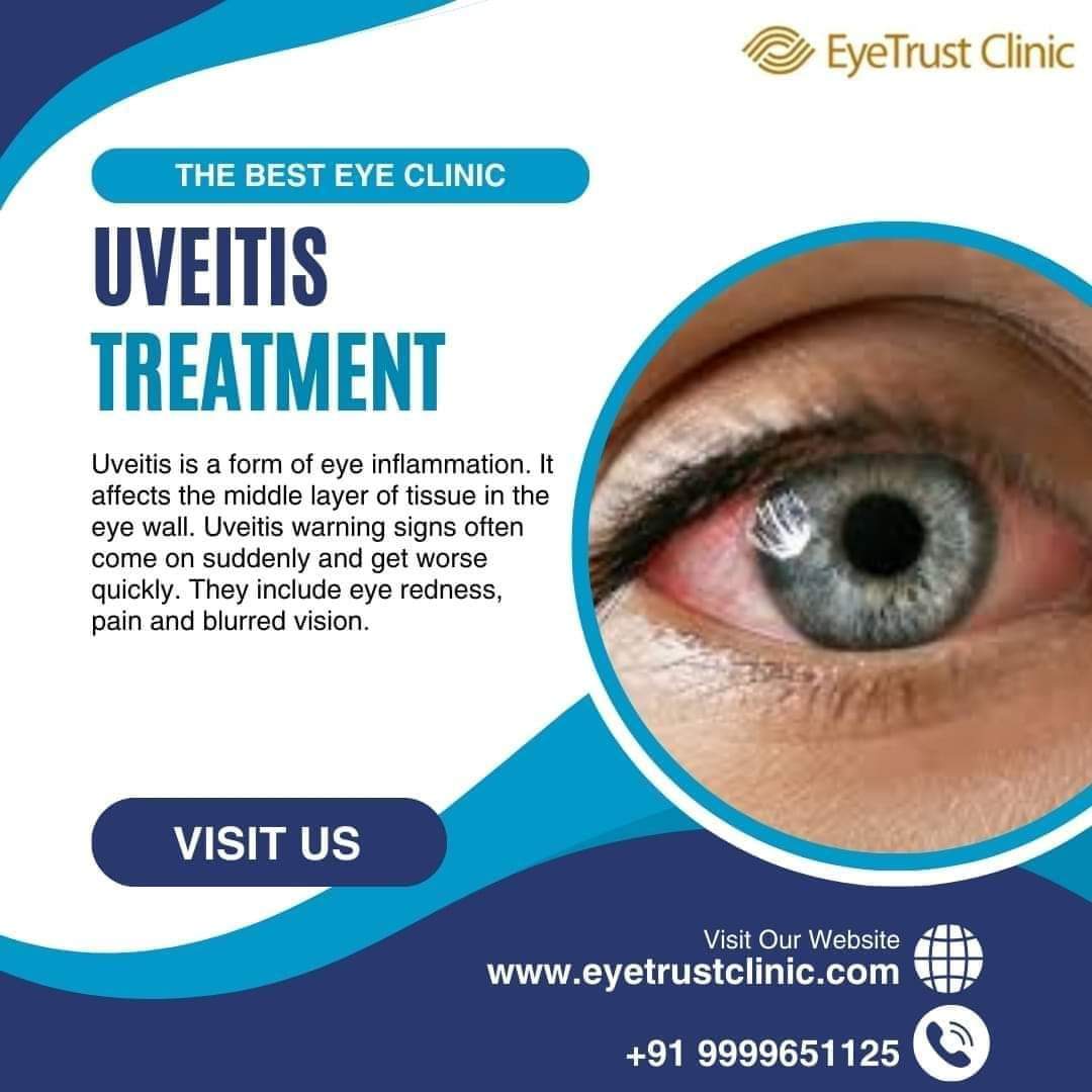 Eyetrustclinic's tweet photo. 👁️ Are You Struggling with #Uveitis ? 
Call us on +91-9999651125 | (+91)-8377096565
 Visit: https://t.co/gouz3A2iV2
#retina #eyedisease #visionproblems #eyesurgery #UveitisTreatment #EyeTrustClinic #EyeHealthMatters #ExpertCare 👩‍⚕️🏥 https://t.co/PQq5PBgq5x