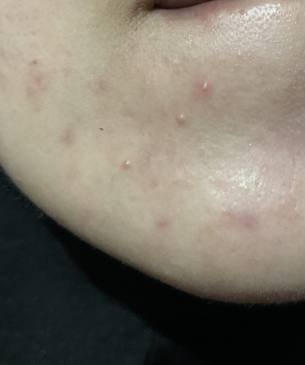 Actually dia buang jeee wehh segala bakteria yang ada dalam jerawat tu ,So boleh nampak yg lubang pori tu dah terbukak means patch tu memang dah serap kekotoran yang ada dalam pori. It just that lepas bukak I tepek patch tu merata so tak tau kat mana jadi tak nampak all the gunk