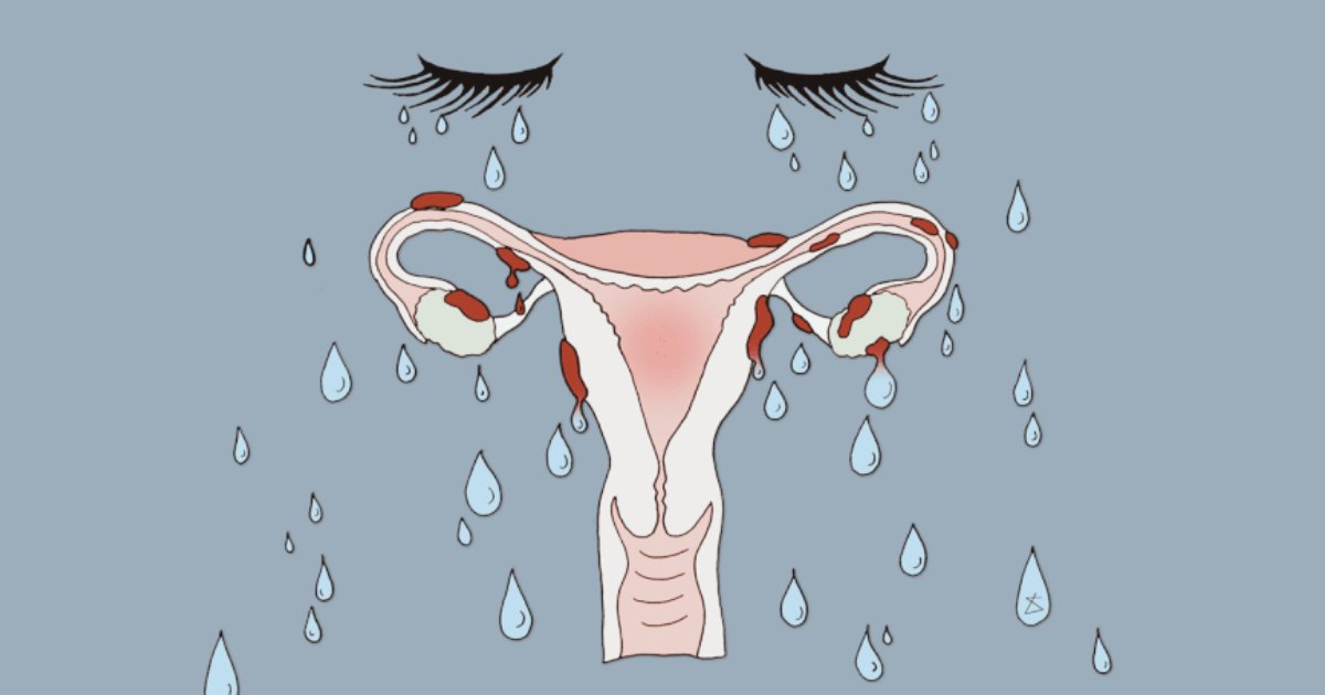 JObstetrics's tweet image. Premenstrual dysphoric disorder (PMDD) is a more serious form of premenstrual syndrome (PMS). It causes physical and emotional symptoms every menstrual cycle in the week or two before period.
#premenstrual #dysphoric #menstrual #anxiety #depression #bloating