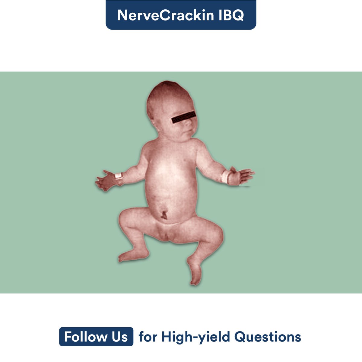 Identify the condition shown in the image? 

A) Cerebral Palsy 
B) Autism Spectrum Disorder 
C) Down Syndrome 
D) Fragile X Syndrome 

#DigiNerve #IBQ #NerveCrackin #QuizTime #MedicalStudents #MCQs #TestYourKnowledge #ImageBasedQuestion #cerebralpalsy ##Autism #Spectrum #Fragile