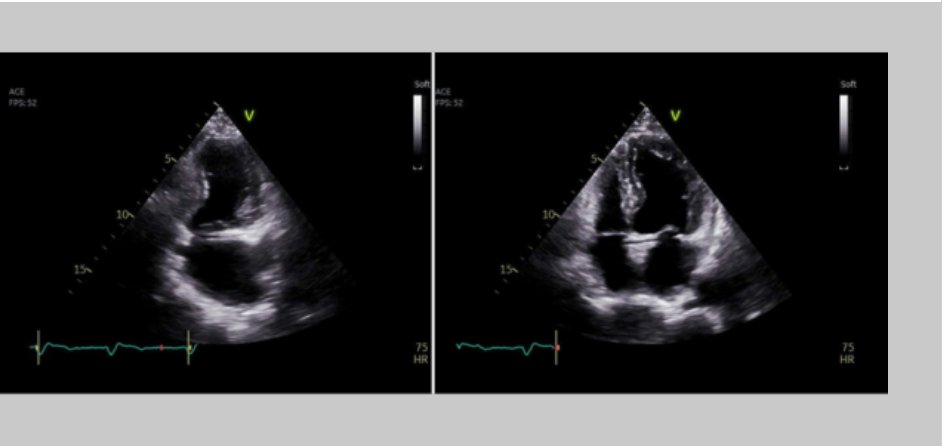 echo_stepbystep's tweet image. #ImageoftheWeek This week&apos;s quiz was submitted by André Lobo at al. from the Cardiology Department, Unidade Local de Saúde Gaia e Espinho, Vila Nova de Gaia, 🇵🇹
In the presented #echofirst images, which finding is identifiable? ☑️shorturl.at/QkRbt
@EACVIPresident