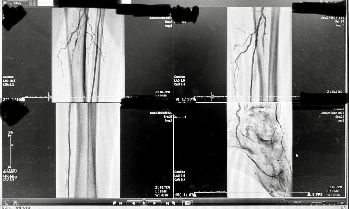 markzroland's tweet photo. Limb-saving is a marathon, not a sprint ๐ฆต๐
#endovascular #interventioncardiologist #peripheralintervention https://t.co/3LrsTGyVIQ