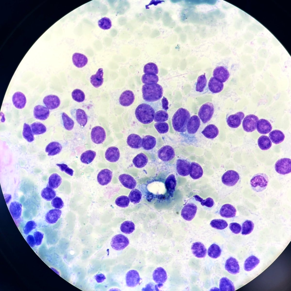 A non-palpable nodule 4,3*2,7 in a right lobe of the thyroid in a 56 yo man. The cellularity is low. But I found this large fragment of stroma with a small number of thyroid cells. The patient had also few small nodules in both lobes. What Bethesda category do you prefer?