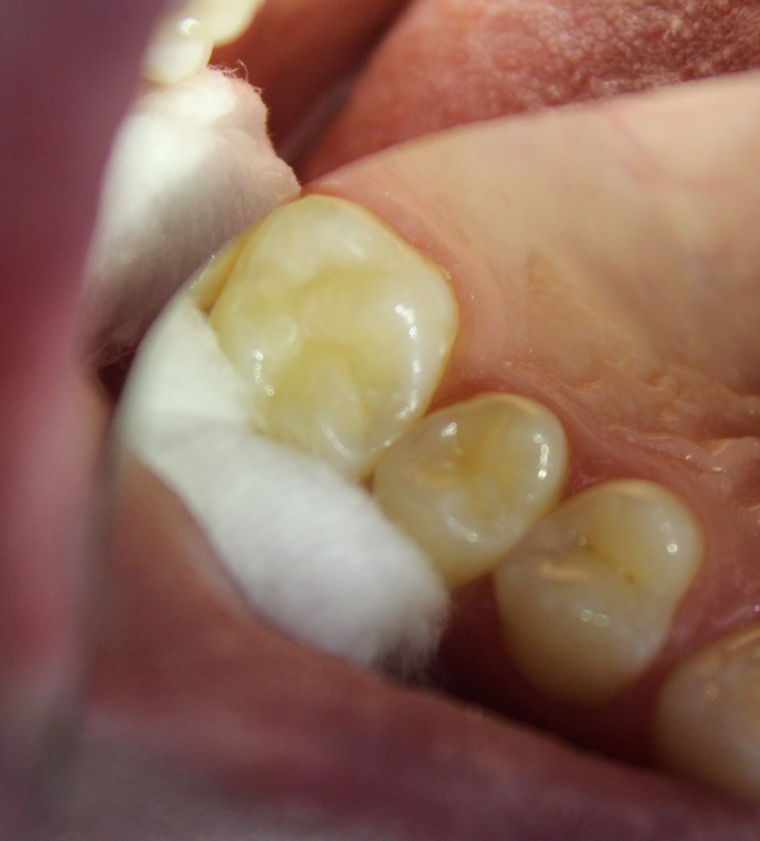 DmitriyZhukov16's tweet image. my restoration tooth 1.6 
#Dentists  #work #pulpitis