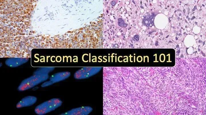 JMGardnerMD's tweet photo. Sarcoma 101 - Bone &amp; Soft Tissue Tumor Classification/Names Made Simple video: https://t.co/9OwCAOEWrK . My 2021 lecture for NCI SEER cancer registrars. Also good for #medstudents, jr. #pathologists, ortho/oncology, &amp; patients/family. #medtwitter #pathology #orthotwitter https://t.co/cJvbT8cXWE