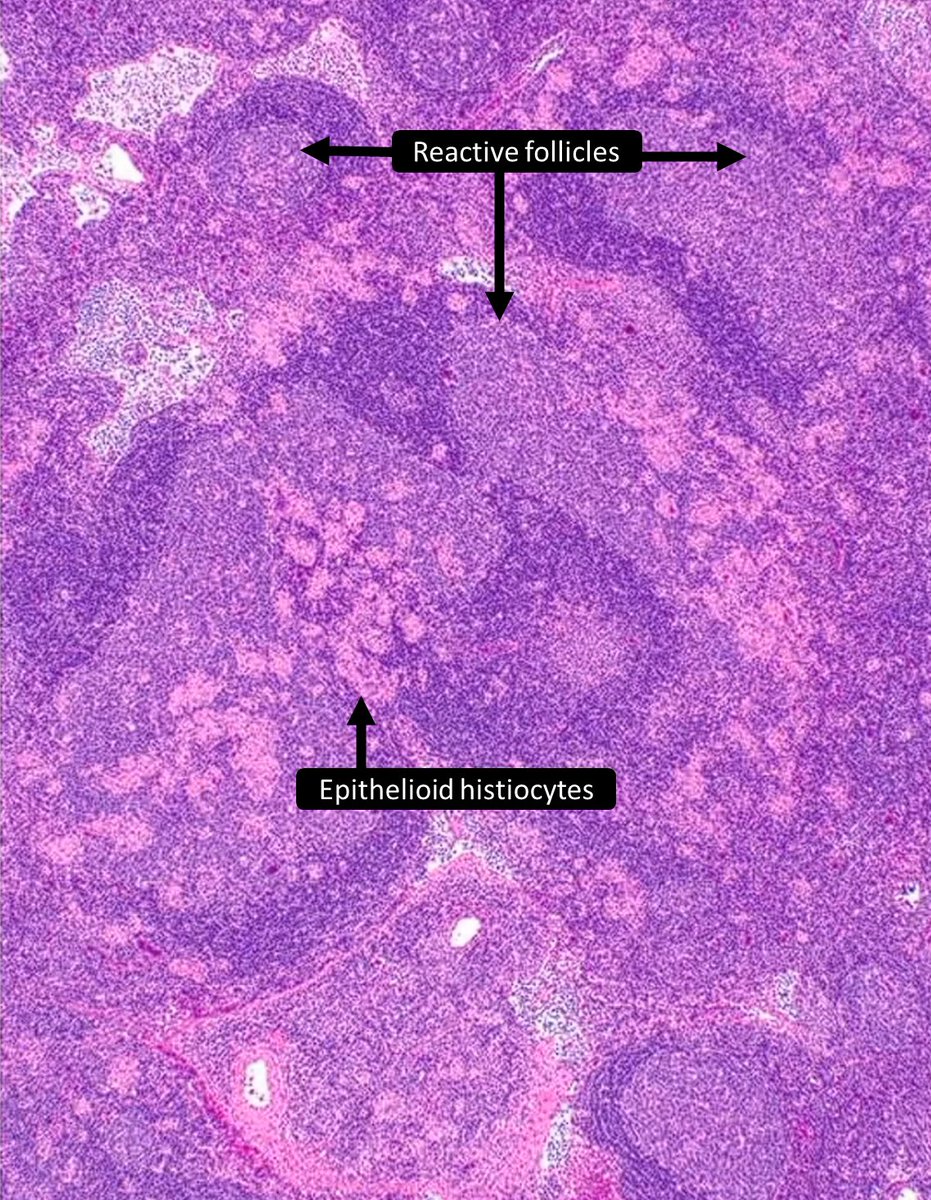 DrCycloPath's tweet photo. Toxoplasma lymphadenitis classically demonstrates
a) monocytoid B cell hyperplasia
b) reactive follicular hyperplasia
c) epithelioid histiocytosis
d) all of the above
#HemePath #PathTwitter #Pathology
