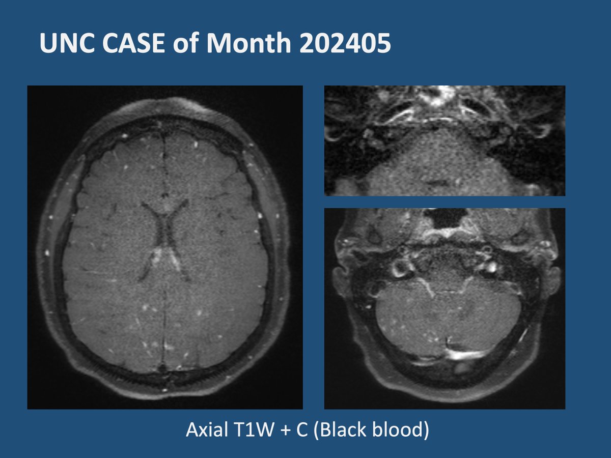 unc_neurorads's tweet image. 🌟 Thank you for your patience! 🌟 The May case is now live! 🎉

[UNC Case of Month 202405]
50-year-old female presented with headache, vertigo, and acute hearing loss. Diagnosis?

@UNCRadiology @UNCRadRes
 #neuroradiology #neurology #migraines #hearingloss #autoimmune #foamed