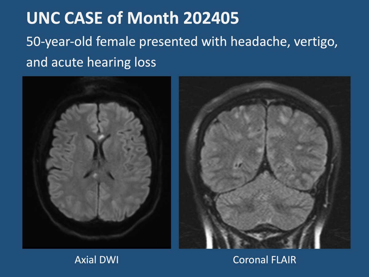 unc_neurorads's tweet image. 🌟 Thank you for your patience! 🌟 The May case is now live! 🎉

[UNC Case of Month 202405]
50-year-old female presented with headache, vertigo, and acute hearing loss. Diagnosis?

@UNCRadiology @UNCRadRes
 #neuroradiology #neurology #migraines #hearingloss #autoimmune #foamed