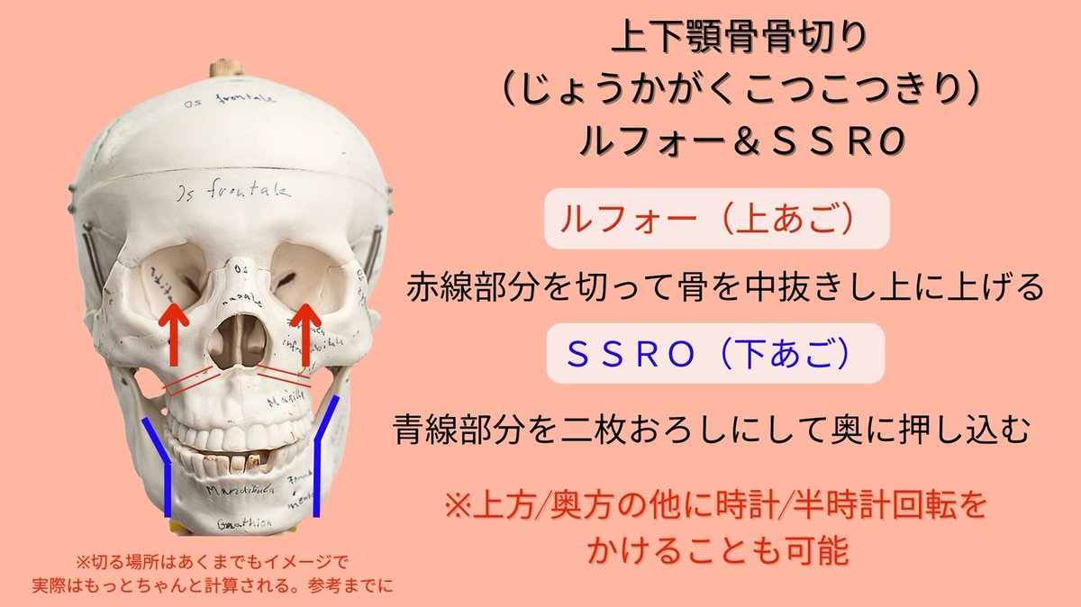 COPPY1st's tweet photo. 【両顎手術まとめ】#美容 #整形
※4枚目の動画は術後イメージ

両顎手術で骨自体が小さくなっても皮膚自体はそのまま
→ほっぺたに肉がたまる/顎下が弛む→ぽよぽよした顔になる

骨を切る量でこのリスクは調整出来るのか、余った皮膚を取り除けるか、ピタッとタイトニングできる方法が https://t.co/86SGCGheDs