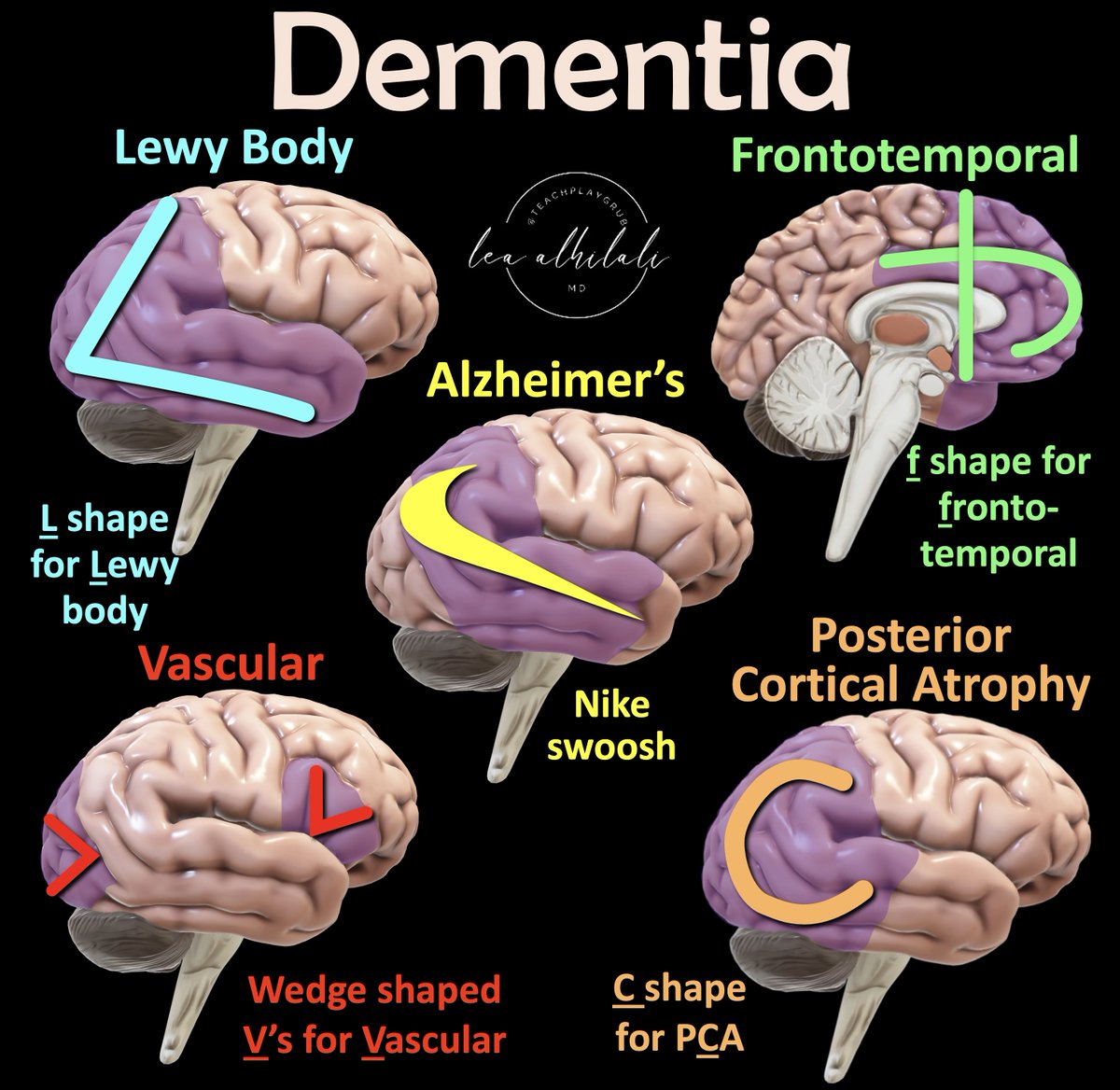 Have some mild cognitive impairment trying to remember dementia patterns on imaging?

Is looking at dementia PET scans one of your PET peeves?

Have short-term memory loss when you read about dementia imaging?

Here’s a way to remember dementia patterns so you will never forget!