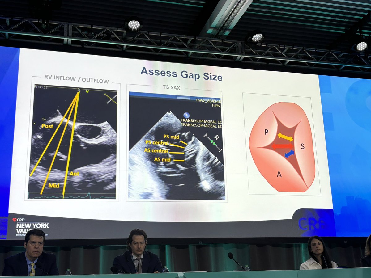 JGrapsa's tweet image. Wonderful lecture by @FabienPraz on the current knowledge on #tricuspid regurgitation #NYvalves2024 @crfheart @MadalinaGarbi @JoaoLCavalcante @EZancanaroMD
