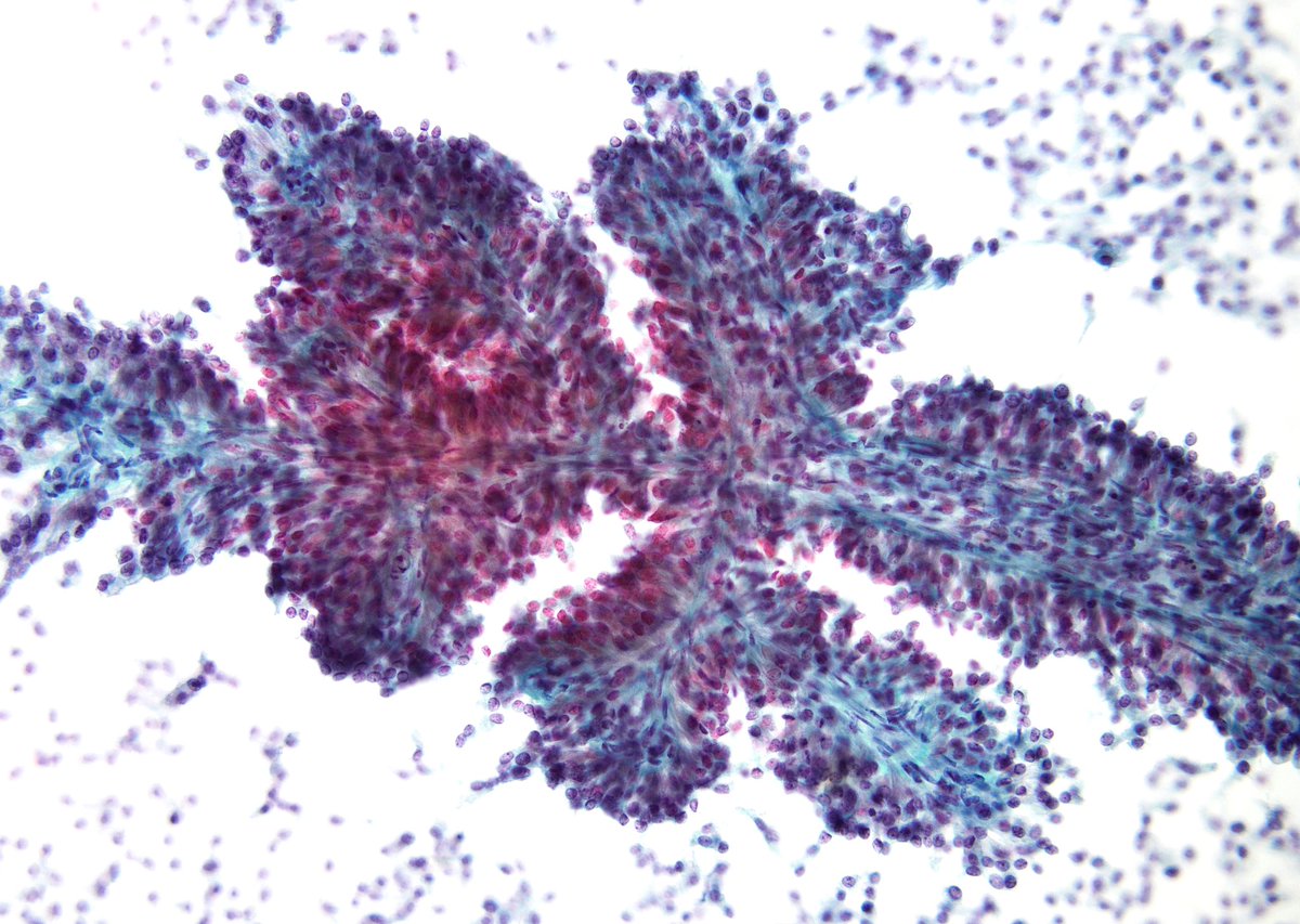 sza_jhcyto's tweet photo. CLASSIC example of an IPR (Instant Pattern Recognition) in Pancreas - Solid Pseudopapillary Neoplasm. (EUS-FNA, Pancreas) https://t.co/5xHOY4w3vk