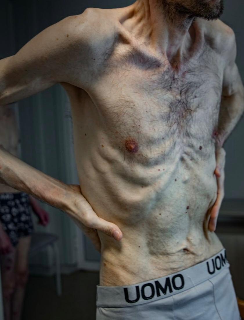 Podolyak_M's tweet photo. Ukrainian servicemen who have been in Russian captivity look horrifying after all they have been through. The torture by starvation is monstrous, the beatings and violence are sophisticated.

In XXI century, #Russia shows what people went through in #Nazi concentration camps during the World War II.

Why is this possible now? 
Because Russia has nullified international law and all the Conventions. There are no #GenevaConventions anymore. And not only them. 

Because Russia again thinks it can avoid being held accountable for massive war crimes. Because there are still sometimes heard voices of people who continue to insist on the ridiculous - "and let's talk to Russia, let's sign peace agreements with Russia".

All this is purest fiction - Russia will torture people in the best Nazi practices until it loses...