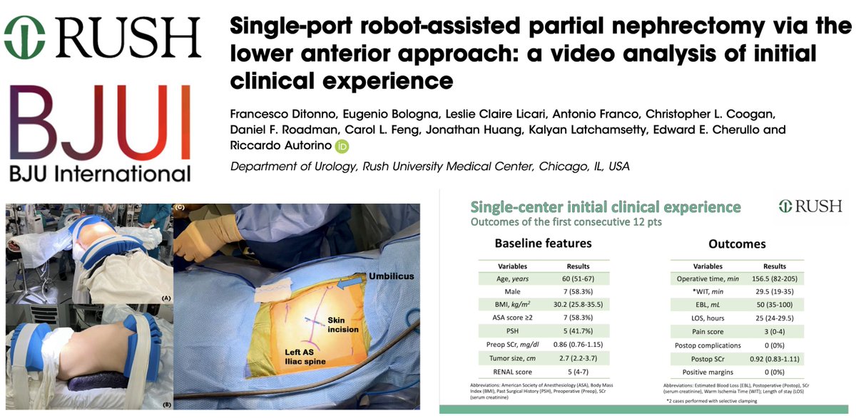 Francesco Ditonno (@franditonno) on Twitter photo Our single-center experience with LAA for kidney surgery now published on <a href="/BJUIjournal/">BJU International</a>
- LAA can be rapidly implemented (Λ5 cases)
- Easy access to renal hilum allows to modulate clamping strategy
- Extraperitoneal route fosters quicker recovery
doi.org/10.1111/bju.16β¦ Our single-center experience with LAA for kidney surgery now published on <a href="/BJUIjournal/">BJU International</a>
- LAA can be rapidly implemented (Λ5 cases)
- Easy access to renal hilum allows to modulate clamping strategy
- Extraperitoneal route fosters quicker recovery
doi.org/10.1111/bju.16β¦