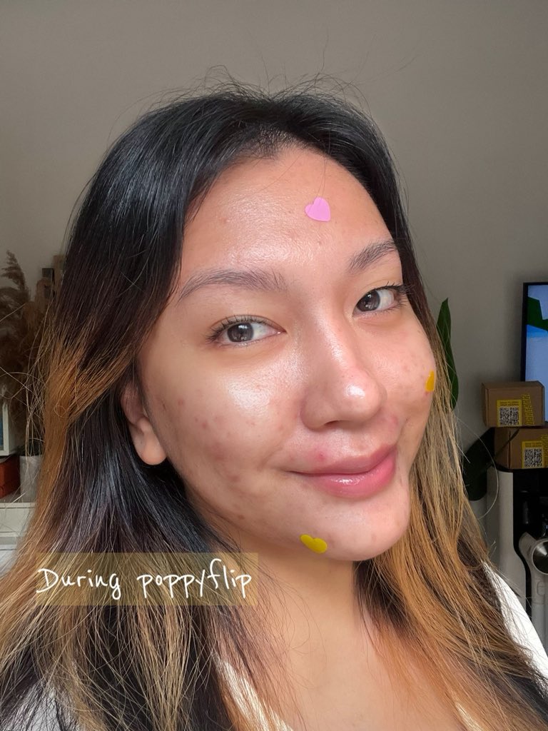 shiidasham's tweet photo. Omg. This is disgusting but I just have to show u the after. Yang banyak2 tu I apply hari lain. They sucked all the pus I had on my face. 

Nasib baik @tatagaltier @aushmilby dah start jual their pimple patch!!  But in all seriousness, u should get one! https://t.co/3ko250DFCq