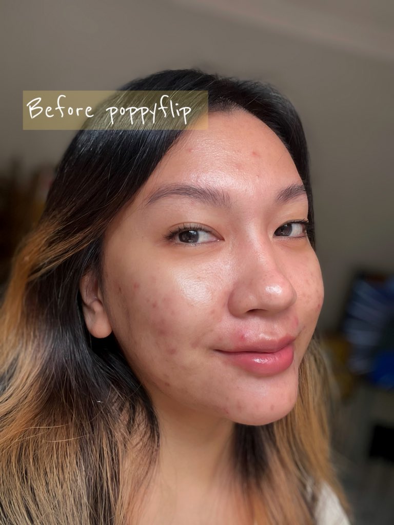 shiidasham's tweet photo. Omg. This is disgusting but I just have to show u the after. Yang banyak2 tu I apply hari lain. They sucked all the pus I had on my face. 

Nasib baik @tatagaltier @aushmilby dah start jual their pimple patch!!  But in all seriousness, u should get one! https://t.co/3ko250DFCq
