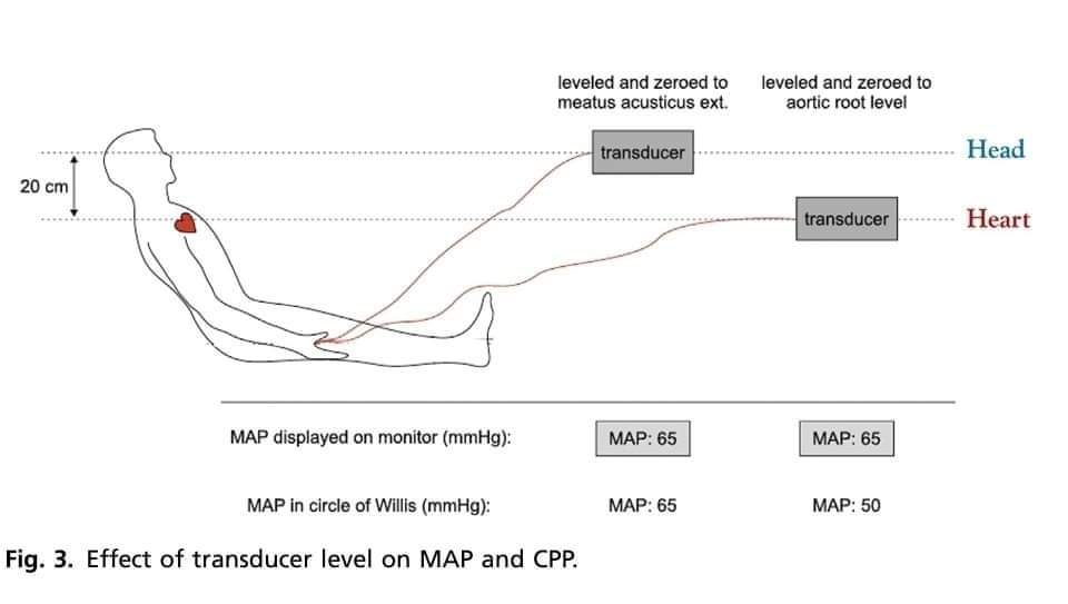 LeslieMegom's tweet photo. ➡️Manejo de Neurotrauma🧠🩸 y Presión Intracraneal💥💥💥💥
NEUROPROTECCIÓN: MANTENER EL CEREBRO FELIZ 😊
🟣El manejo de un cerebro lesionado 🩸🧠debe centrarse en mantener la homeostasis normal.
💥7 elementos del concepto de "cerebro feliz": 
1️⃣EUtermia.
2️⃣EUglucemia. 
👇 https://t.co/XgaEUREsFB