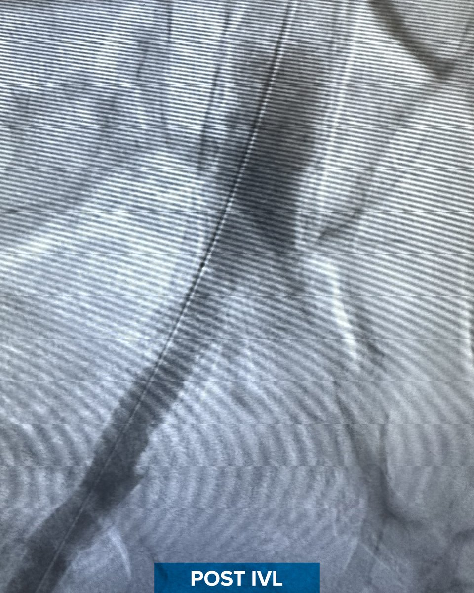Shockwave Medical (@shockwaveivl) on Twitter photo 62yo male with bilateral #CLTI, recent right ATK amputation and non-healing foot wounds of the left lower extremity. Declined for surgical revasc.
Dr. <a href="/academicaorta/">Saideep Bose MD, MPH</a> at <a href="/SSMHealth/">SSM Health</a> St. Mary’s Hospital, St. Louis, performed serial dilatation of the right common iliac CTO with 62yo male with bilateral #CLTI, recent right ATK amputation and non-healing foot wounds of the left lower extremity. Declined for surgical revasc.
Dr. <a href="/academicaorta/">Saideep Bose MD, MPH</a> at <a href="/SSMHealth/">SSM Health</a> St. Mary’s Hospital, St. Louis, performed serial dilatation of the right common iliac CTO with