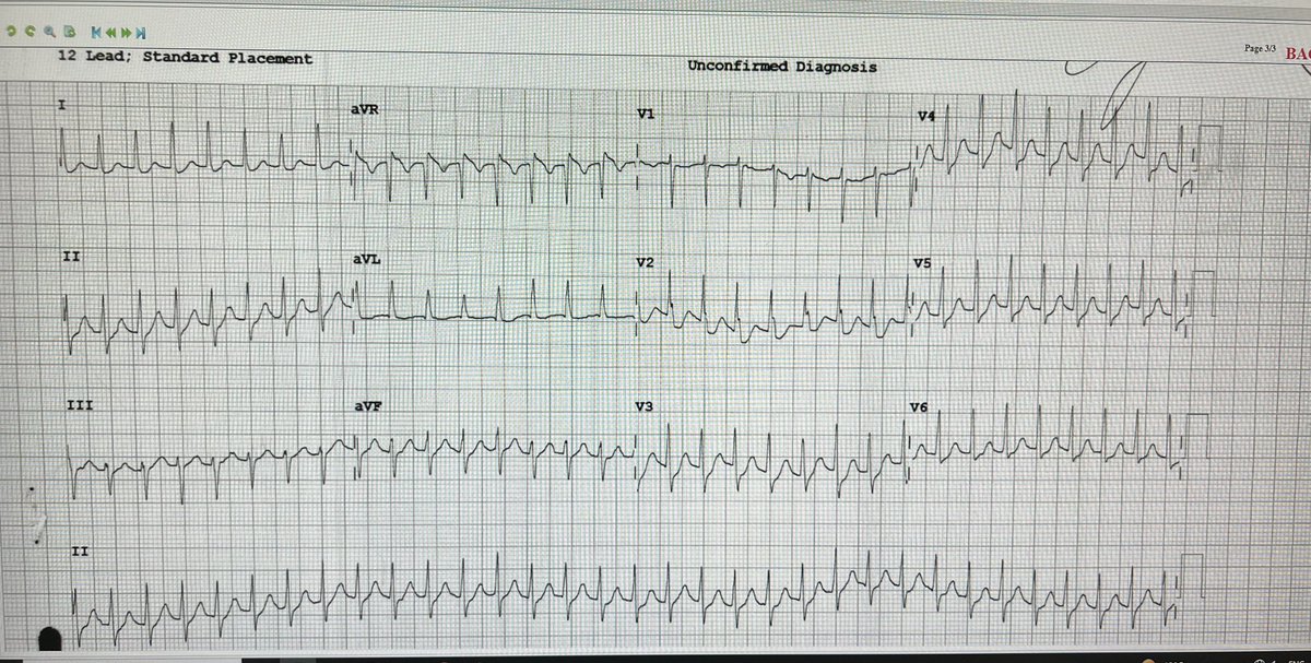 diawsEM's tweet photo. Is it WPW? @smithECGBlog @amalmattu @ekgpress @ECGWeekly @ECGwithReid @EcgOxford https://t.co/8xMhvyp4fL