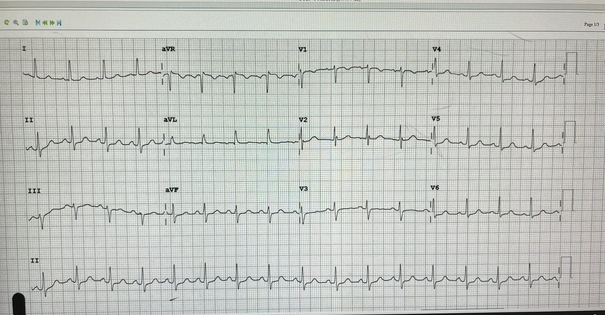 diawsEM's tweet photo. Is it WPW? @smithECGBlog @amalmattu @ekgpress @ECGWeekly @ECGwithReid @EcgOxford https://t.co/8xMhvyp4fL