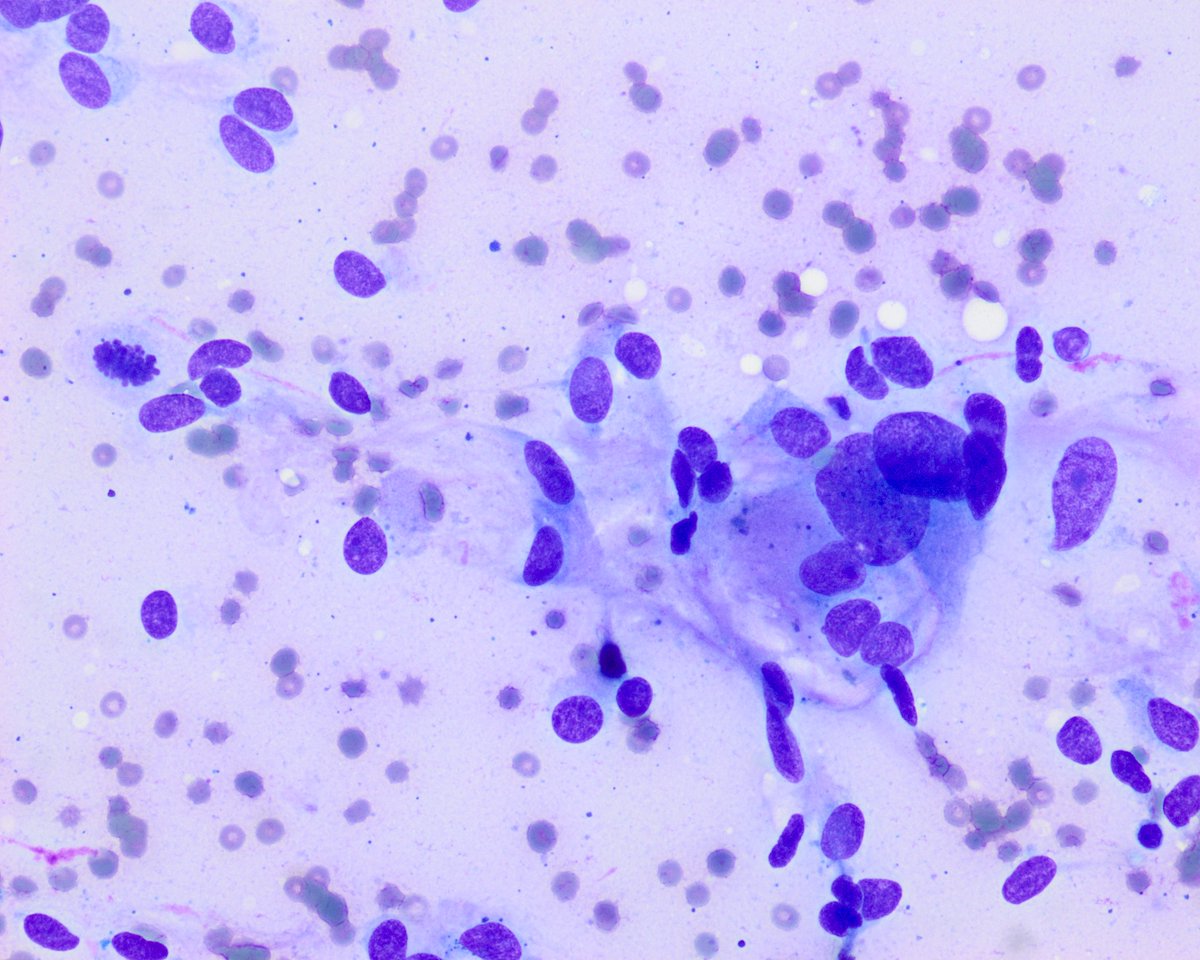 Pepe Jiménez Heffernan (@pepeheffernan) on Twitter photo CC331. Adrenal tumor. Patricia <a href="/pattmh/">Patricia Muñoz</a> loves cytopathology (and likes to test me). We rarely needle this tumor. She sampled a surgical case. When showing it, she says nothing, not even the organ, just gives you the slide. More images below <a href="/DrBMcGinn/">Barry McGinn</a> <a href="/kriyer68/">Kalyani Bambal</a> <a href="/twmarkc/">Mark CC Chen, M.D. FIAC</a> #cytopath CC331. Adrenal tumor. Patricia <a href="/pattmh/">Patricia Muñoz</a> loves cytopathology (and likes to test me). We rarely needle this tumor. She sampled a surgical case. When showing it, she says nothing, not even the organ, just gives you the slide. More images below <a href="/DrBMcGinn/">Barry McGinn</a> <a href="/kriyer68/">Kalyani Bambal</a> <a href="/twmarkc/">Mark CC Chen, M.D. FIAC</a> #cytopath