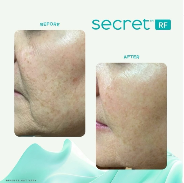lmclaser's tweet photo. Get radiant skin with Secret™ PRO RF! Say goodbye to lines, wrinkles, and dullness. Get smoother, firmer, and glowing skin.

Benefits:
Reduces wrinkles
Tightens skin
Enhances texture

👉 Book now!

*Results may vary.
#SecretPRO #SkinRenewal #AgelessBeauty #YouthfulSkin #SkinCare https://t.co/B2d9gCQIWX