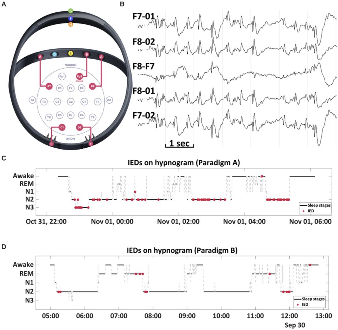 This report demonstrates the need to personalize DBS settings, tailoring them to individual patients’ sleep patterns to maximize therapeutic benefits...... frontiersin.org/articles/10.33…