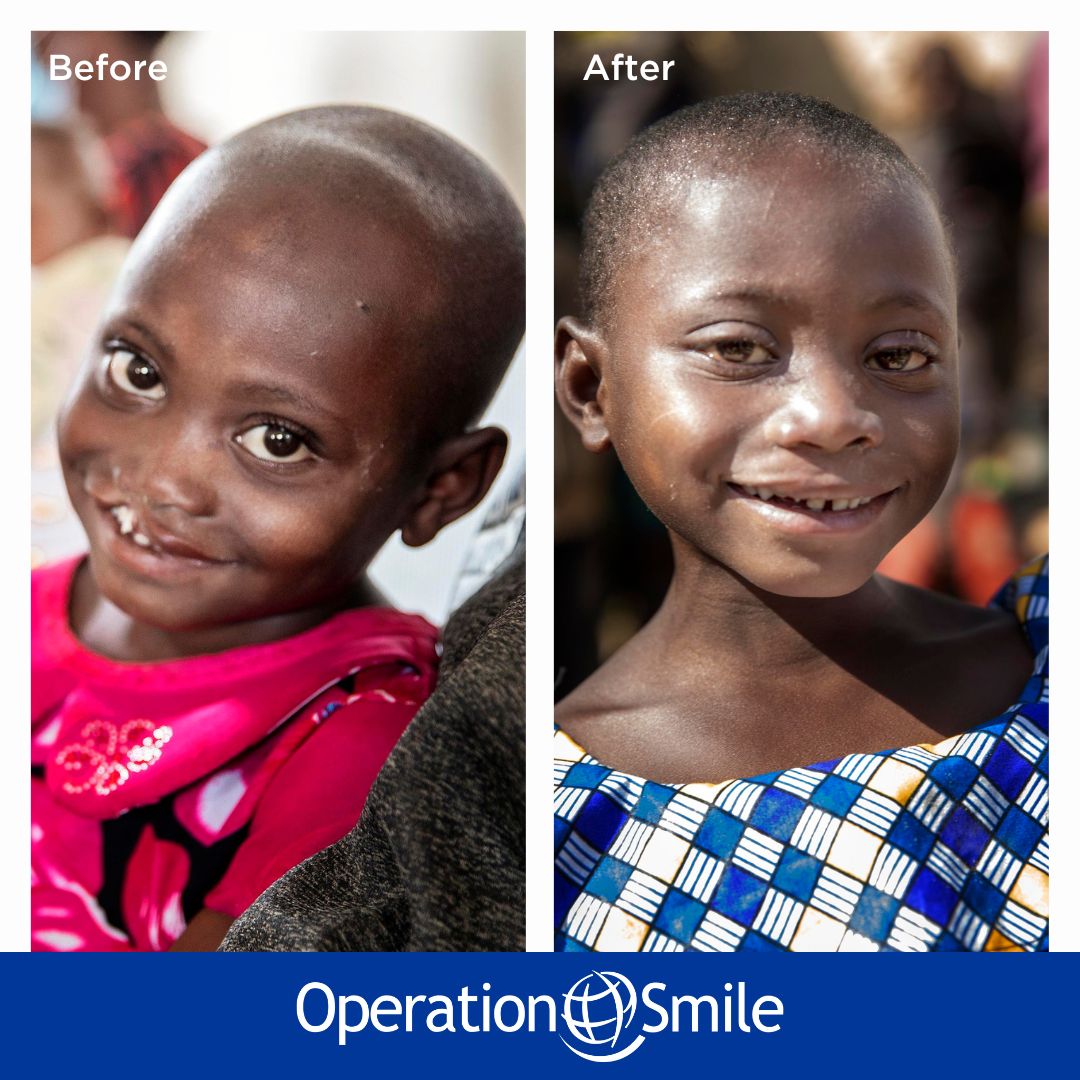 OpSmileUK's tweet photo. Valentine was five when she got her life-changing #cleft surgery. Before that, she'd spent the first years of her life in isolation because other children refused to play with her. Thankfully her parents heard about #OperationSmile on the radio! https://t.co/5iY0CBke1G