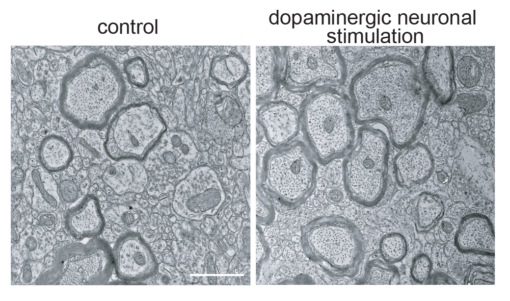 Stanford_Neuro's tweet image. Michelle Monje&apos;s team @Stanford links maladaptive myelination to drug addiction. Opiates such as morphine can trigger myelination of dopamine neurons, driving drug-seeking behavior in mice. This research could shape new strategies for recovery.  #OpiateCrisis #AddictionResearch…