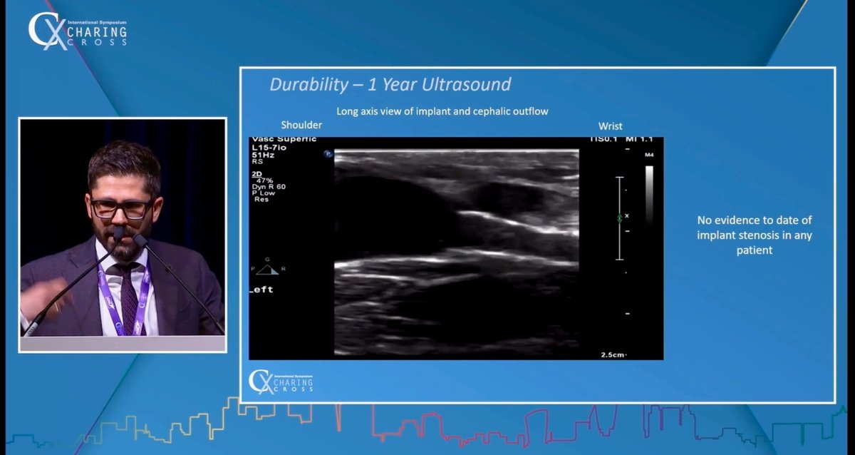 robshahverdyan's tweet photo. Next generation #pAVF devices are coming: >1 year follow up including U/S of First-In-Human patients, treated with the novel next generation Venova Medical #Velocity #pAVF device, are showing no edge-stenosis and excellent performance. Next stop - US feasibility trial this year https://t.co/7Hq4Zg5uD5