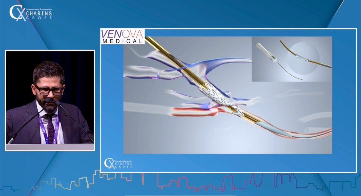 robshahverdyan's tweet photo. Next generation #pAVF devices are coming: >1 year follow up including U/S of First-In-Human patients, treated with the novel next generation Venova Medical #Velocity #pAVF device, are showing no edge-stenosis and excellent performance. Next stop - US feasibility trial this year https://t.co/7Hq4Zg5uD5