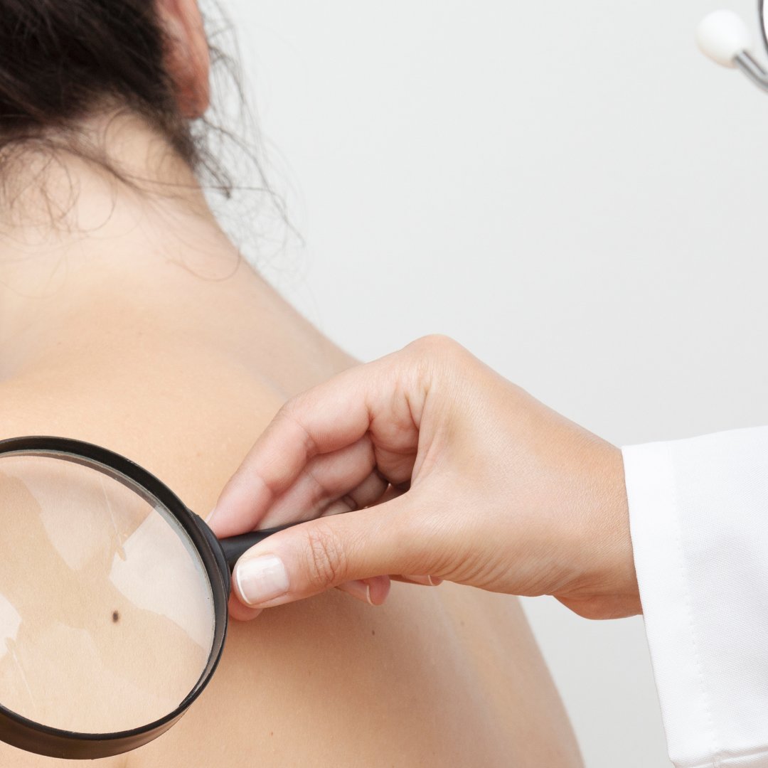 StLukesHealthTX's tweet photo. Los chequeos regulares de la piel son esenciales para detectar el cáncer a tiempo. No subestimes la importancia de visitar a un especialista si tienes muchos lunares o factores de riesgo. #StLukesHealth #EspecializadosEnTi https://t.co/5rjSPpVacf