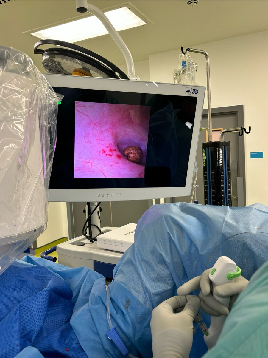 Feras Al Jaafari (@ferasjaafari) on Twitter photo Really nice image, very slick 7.5fr scope and great manoeuvrability! Ooh and .. LEFT scope for the LEFT kidney !
<a href="/novus_med/">novus med</a> <a href="/ShenZhenHugeMed/">Shenzhen HugeMed</a> <a href="/LukeUrology/">Luke Gordon</a> Really nice image, very slick 7.5fr scope and great manoeuvrability! Ooh and .. LEFT scope for the LEFT kidney !
<a href="/novus_med/">novus med</a> <a href="/ShenZhenHugeMed/">Shenzhen HugeMed</a> <a href="/LukeUrology/">Luke Gordon</a>