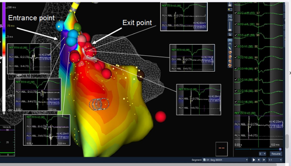Casi2007's tweet photo. Ventricular tachycardia in Carvajal syndrome. First image voltaje map, second image activation map of RVOT reentry https://t.co/HZNQNstwPR
