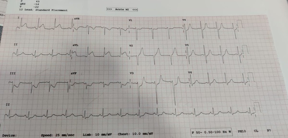 akbarul's tweet image. Importance of South African flag sign in diagnosing a flush occluded diagonal #cardiotwitter