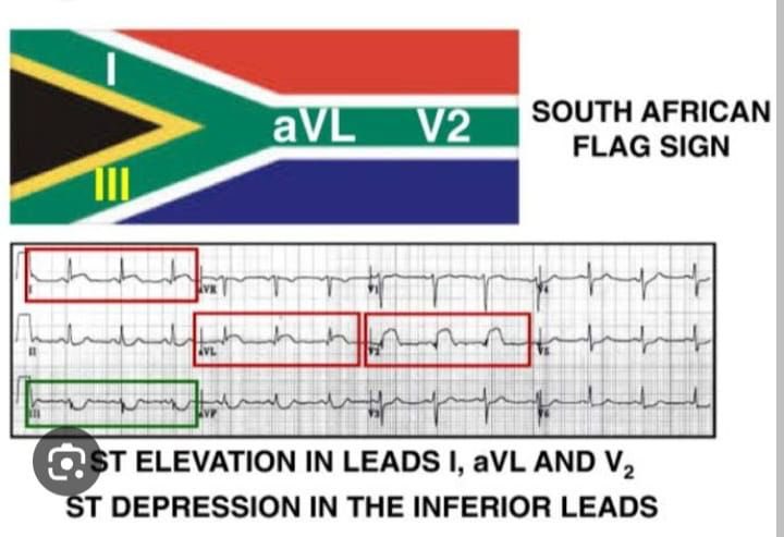 akbarul's tweet image. Importance of South African flag sign in diagnosing a flush occluded diagonal #cardiotwitter