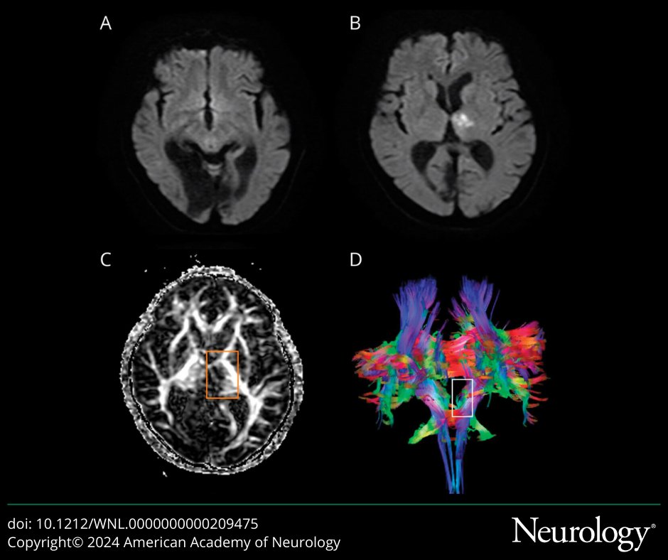 Video #NeuroImage: Wall-Eyed Bilateral Internuclear Ophthalmoplegia Variant Syndrome Caused by Isolated Left Thalamic Infarction bit.ly/3w9V5G2