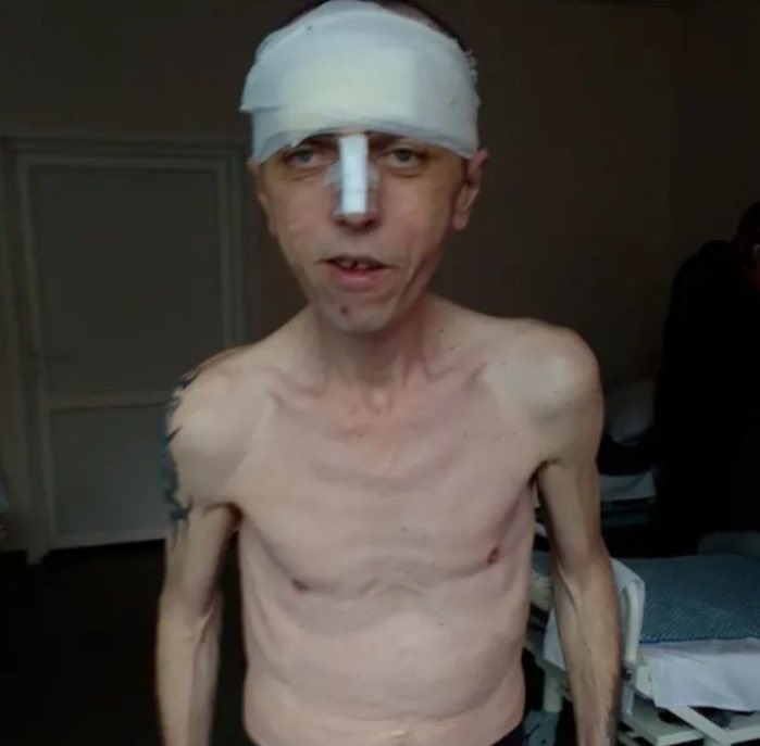 Ukrainian POW about the 🇷🇺 captivity:

“I didn’t die just so I could tell the world about the tortures I’ve been through”