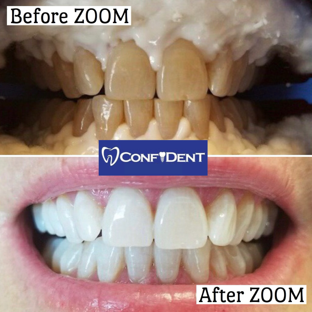 ConfiDenT_LLC's tweet photo. WOW! Look at these amazing results! Our patients are loving #ZOOMwhitening 😎
#ConfiDENTalpharetta #DrCesar #DrHumie #TeethWhitening #BeforeAndAfter #ConfiDENTcumming https://t.co/MlIc8G6LDo