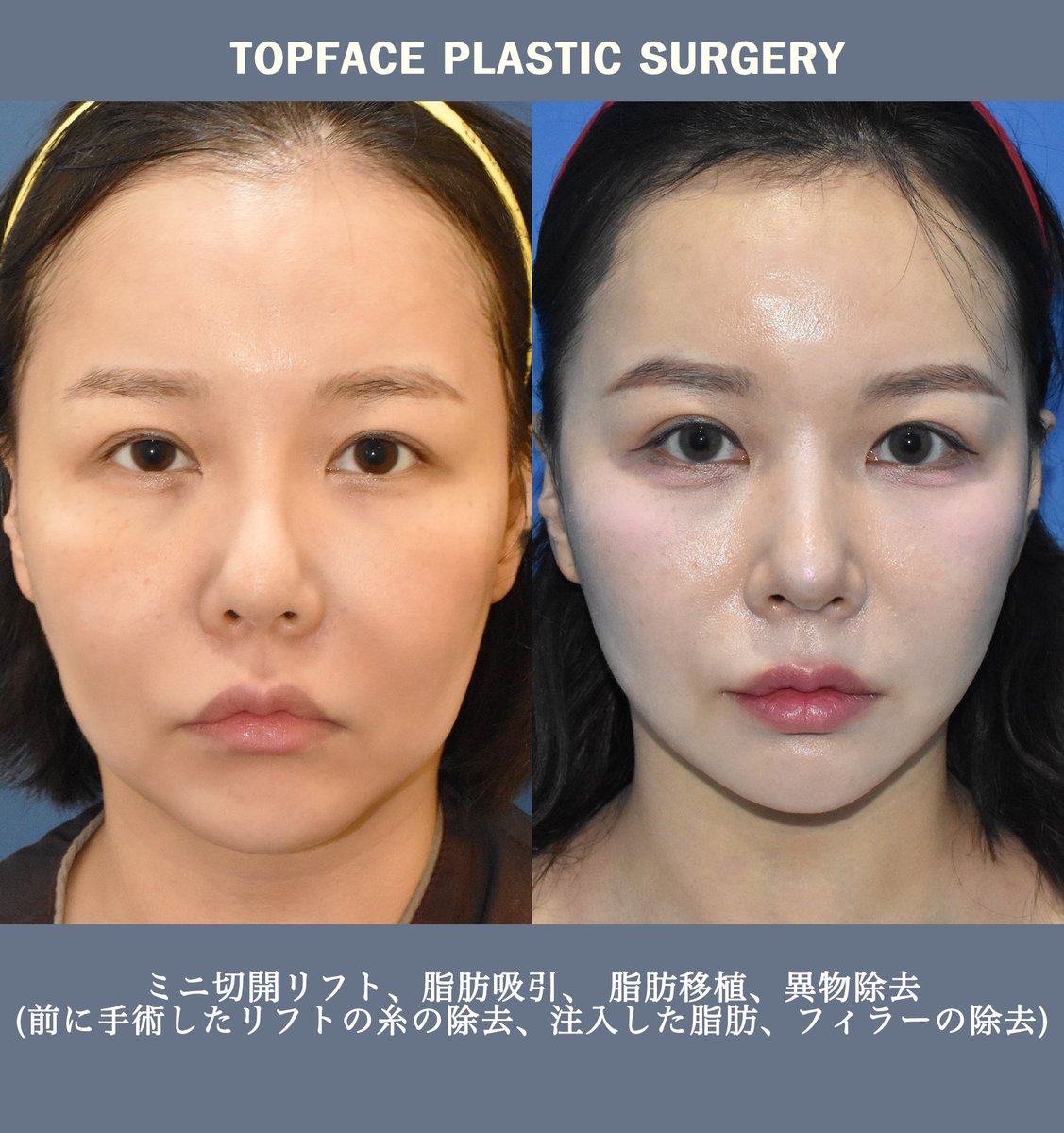 トップフェイス美容外科日本公式(TOPFACE)6月21日東京相談会決定 トップフェイス美容外科日本公式(TOPFACE)6月21日東京相談会決定