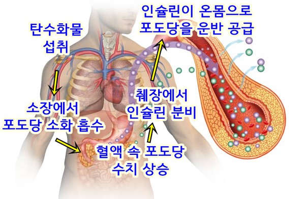 대사증후군이란 무엇인가요 ?

대사증후군이 있는 대부분의 사람들은 인슐린 저항성을 가지고 있습니다.

대사증후군은 함께 발생하는 일련의 질환으로, 심장병, 뇌졸중 및 제2형 당뇨병의 위험을 증가시킵니다.  이러한 조건에는 다음이 포함됩니다.

 1. 혈압이 상승합니다.
 2. 혈당 수치가