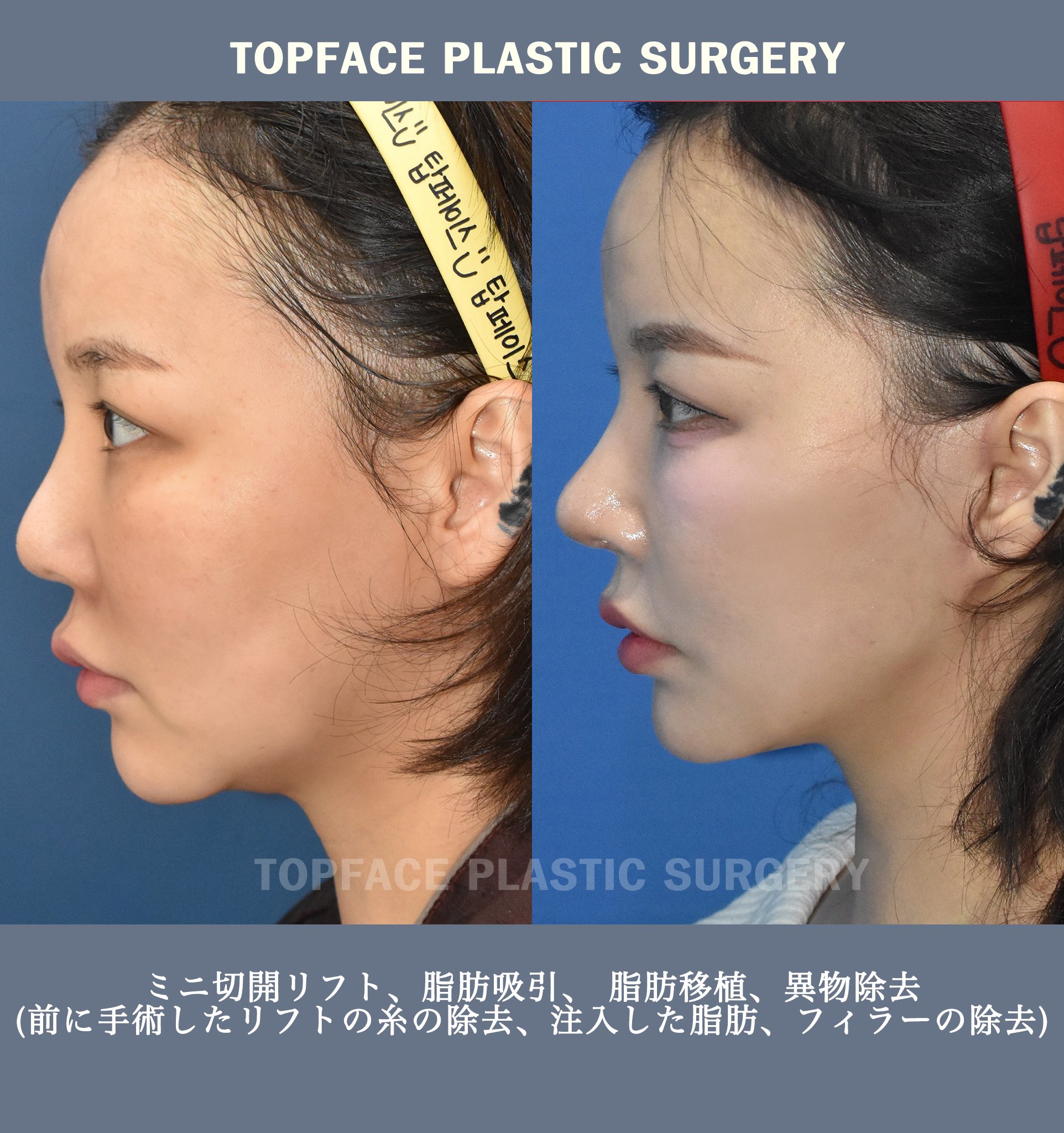 トップフェイス美容外科日本公式(TOPFACE)6月21日東京相談会決定 トップフェイス美容外科日本公式(TOPFACE)6月21日東京相談会決定