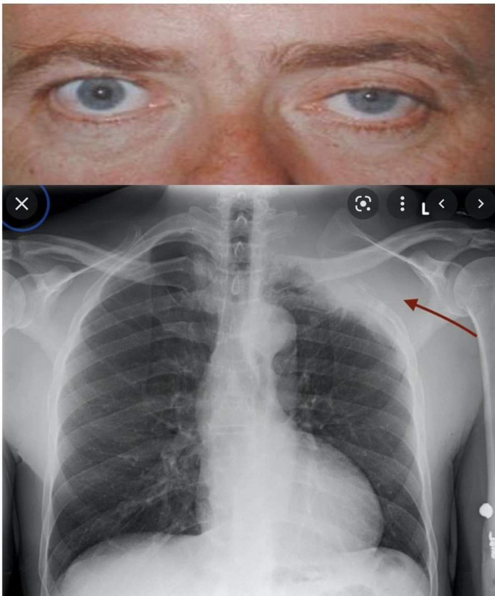 Patient presents with this and X-ray showed this. What is your diagnosis?
